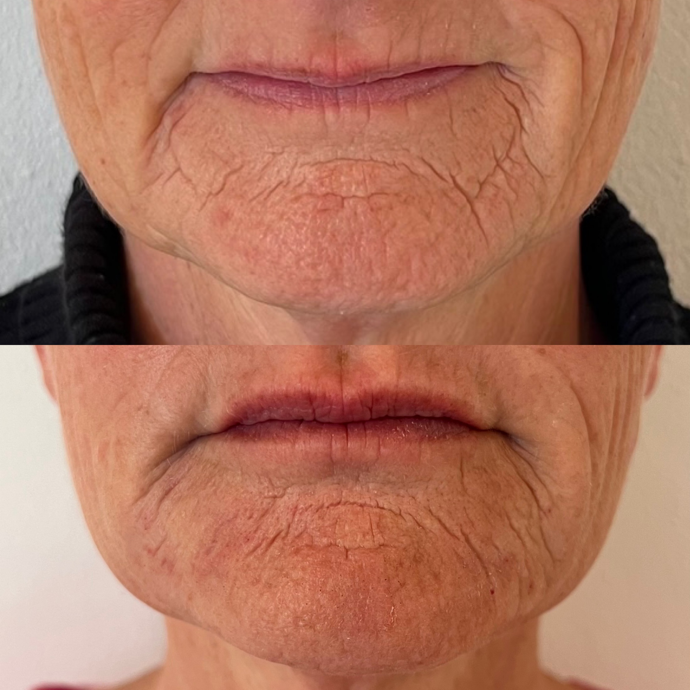 Restylane Skinbooster kurforløb a’ 3 behandlinger