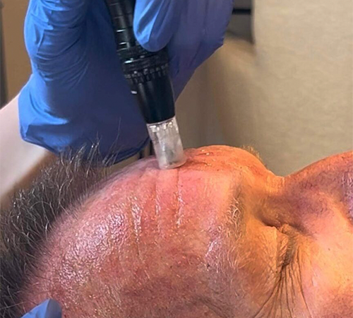 Microneedling