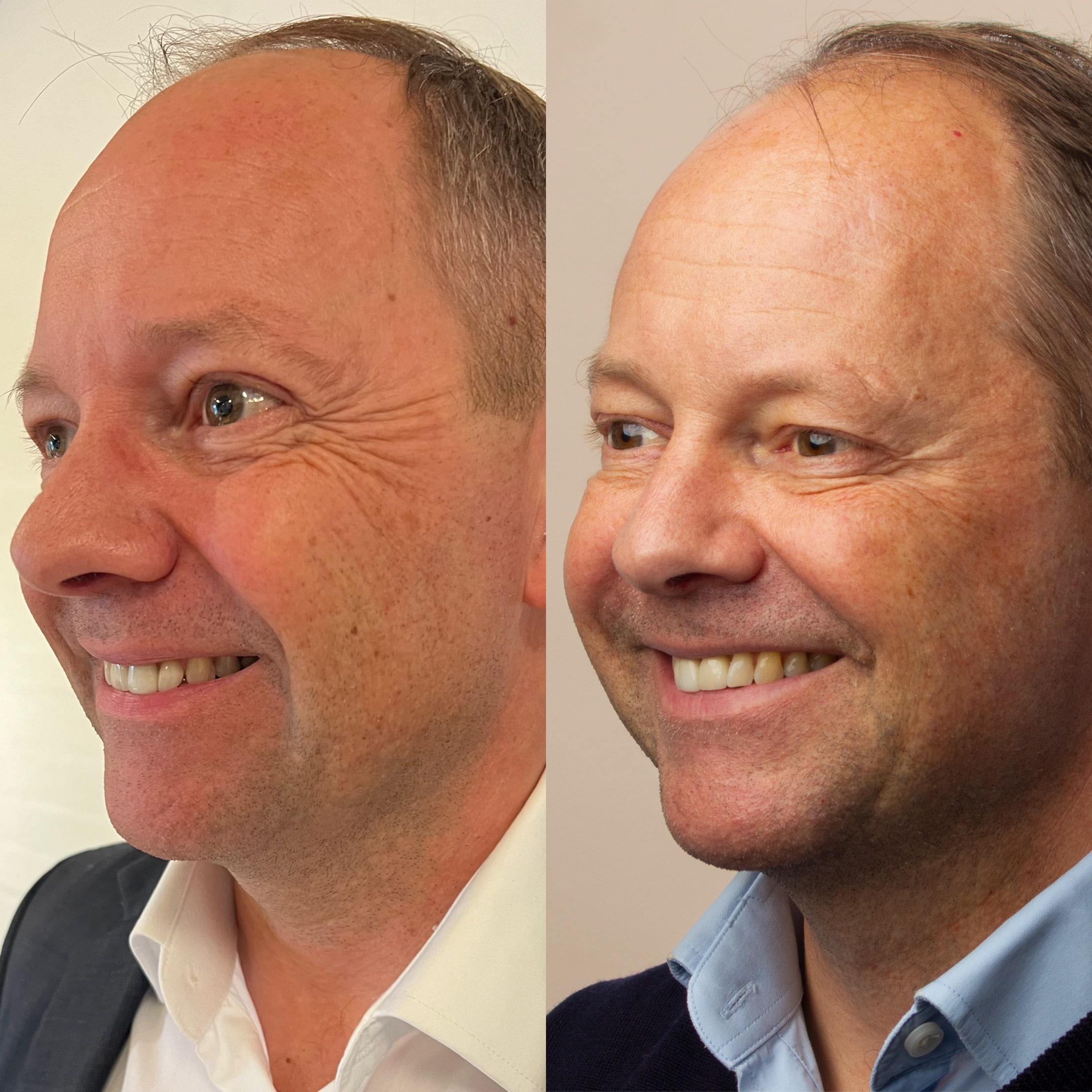 Før- og efterbillede af mand behandlet med botox ved klinik i Odense på Fyn