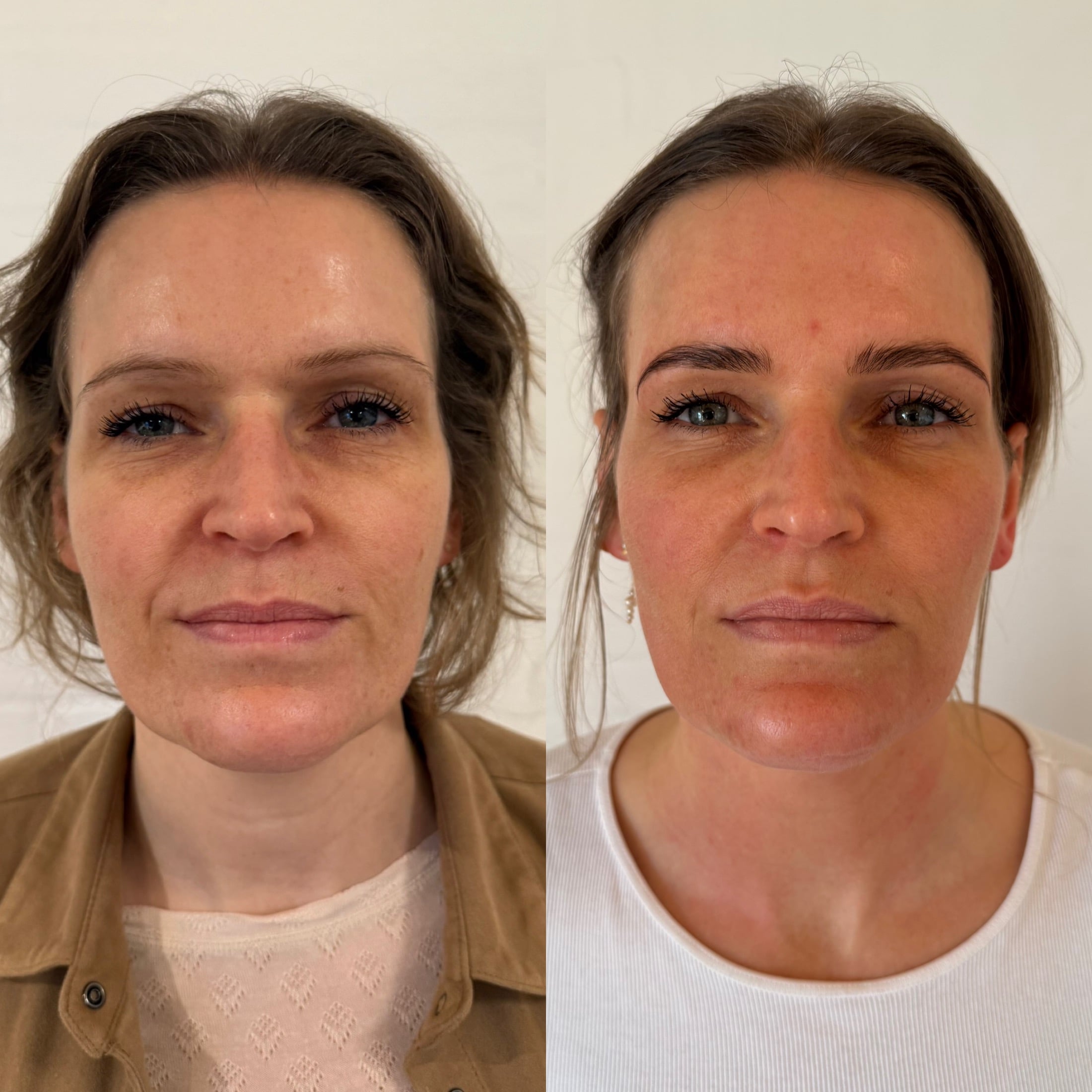Professionel microneedling udført på klinik i Odense