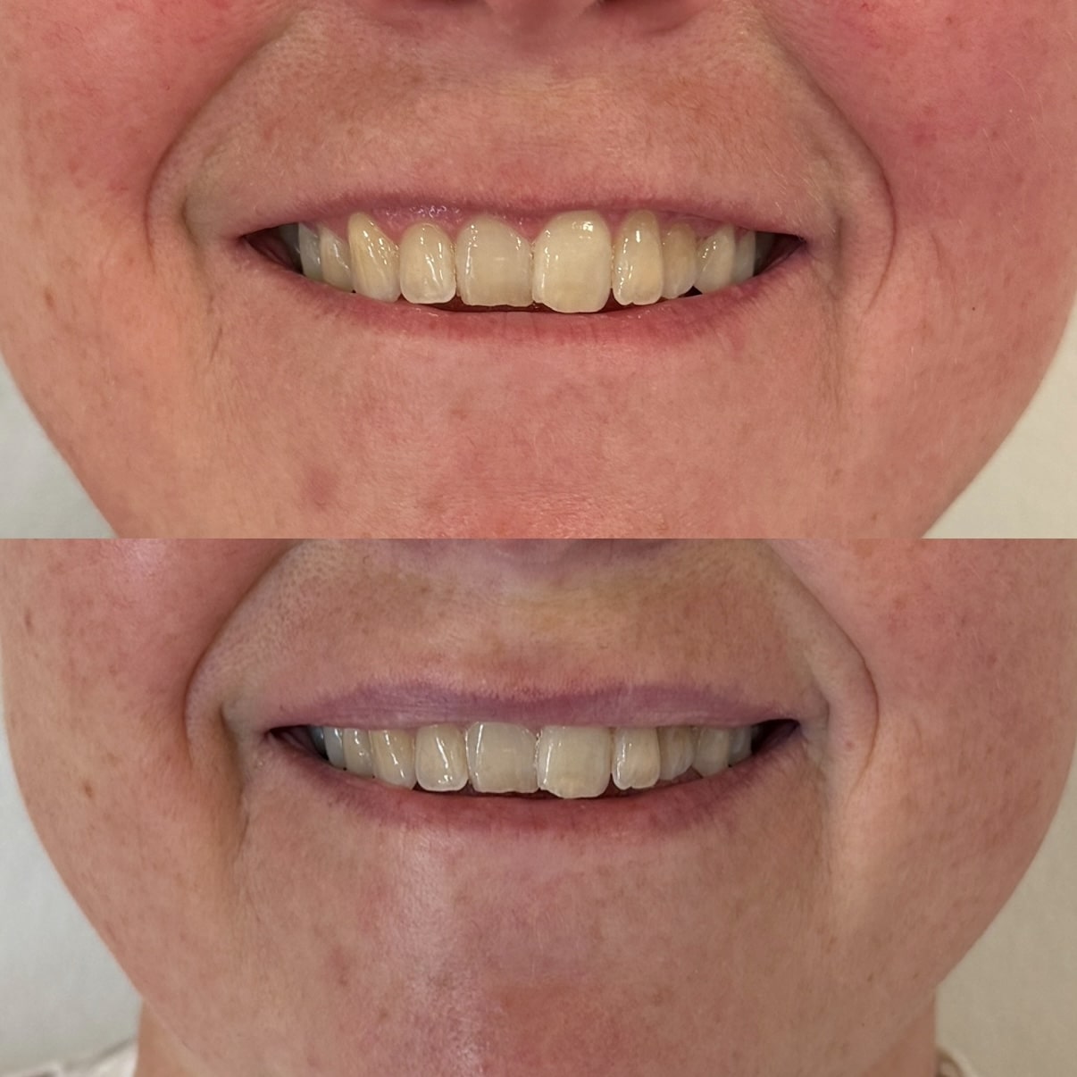 Botox for lipflip på kunde i kosmetisk klinik i Odense