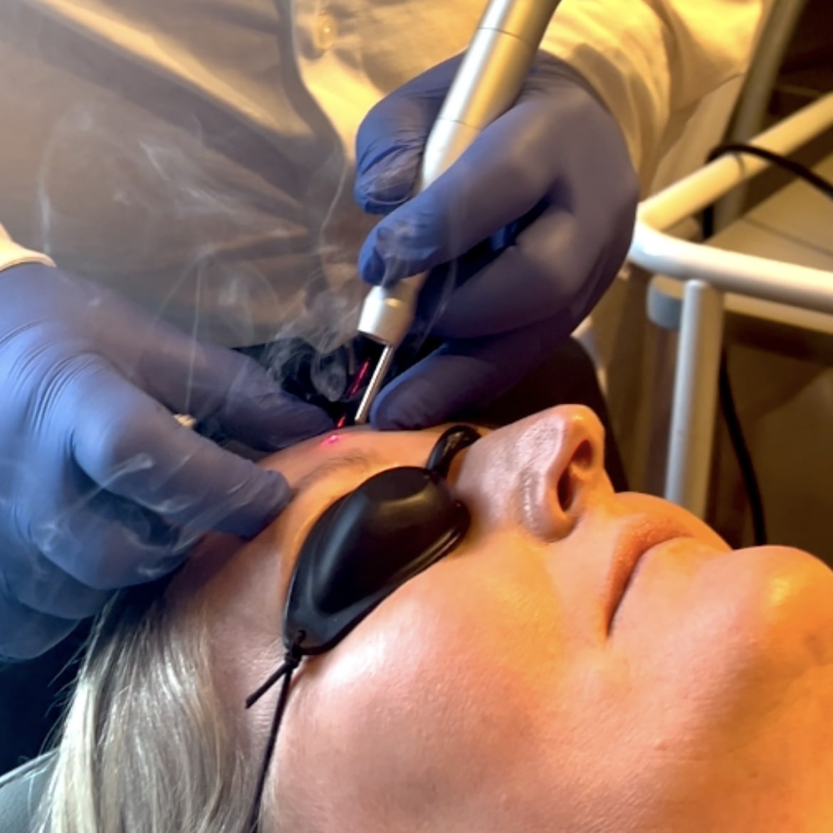 Kvinde får fjernet skintag med skånsom laserbehandling hos Fyrsterling Clinic i Odense