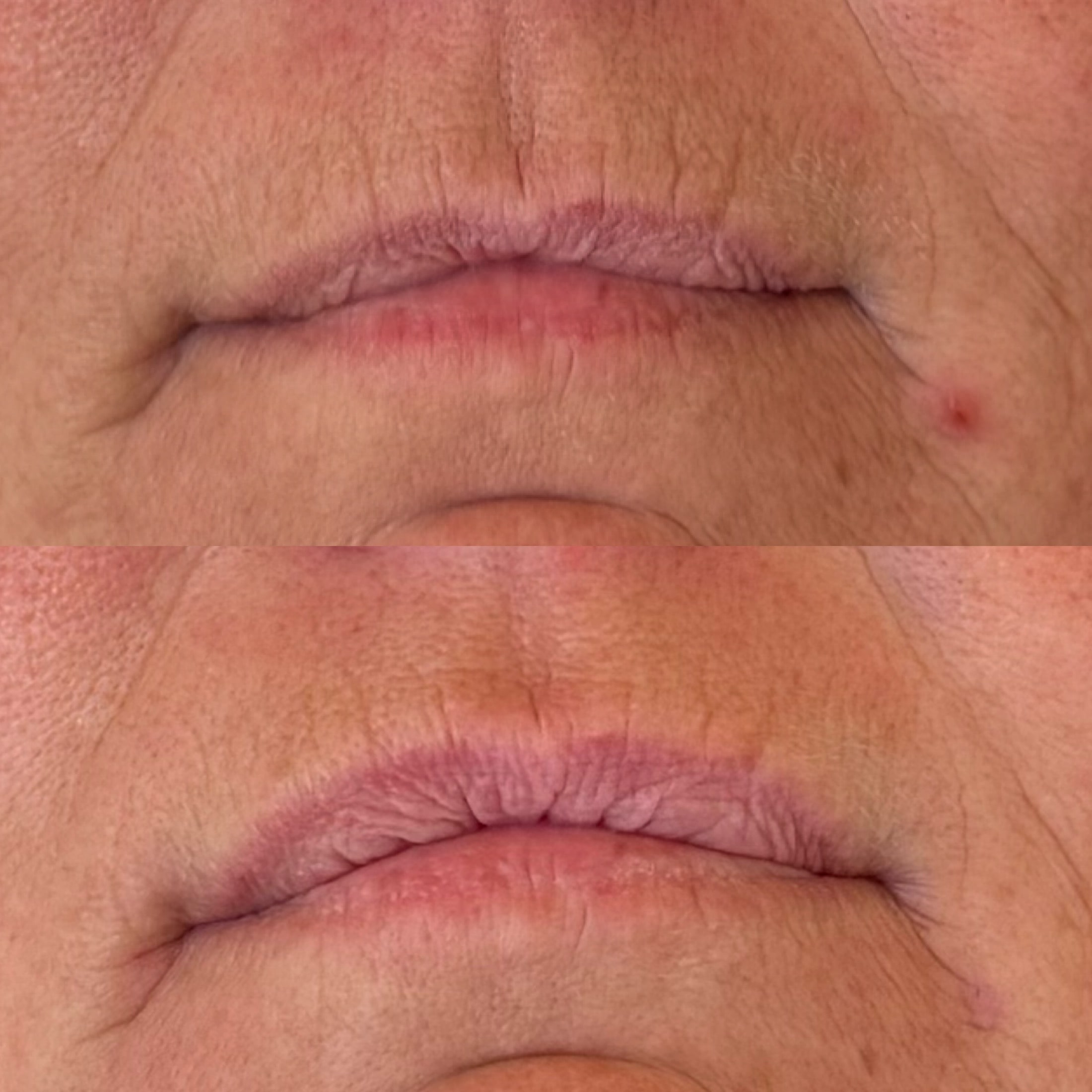 Kunde med linjer ved munden før og efter 