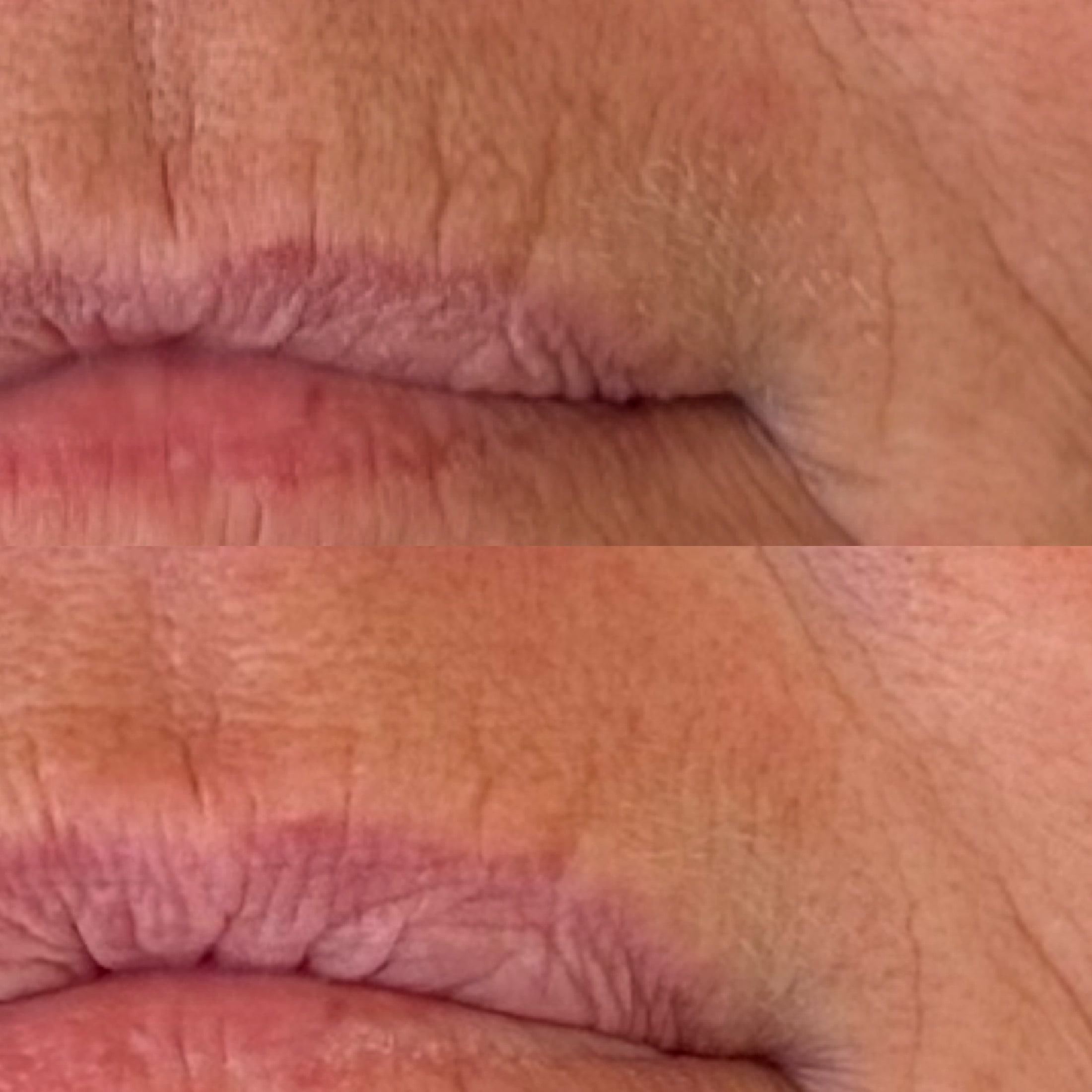 Behandling til rynker om munden hos kosmetisk klinik Odense tæt på Nyborg og Kerteminde