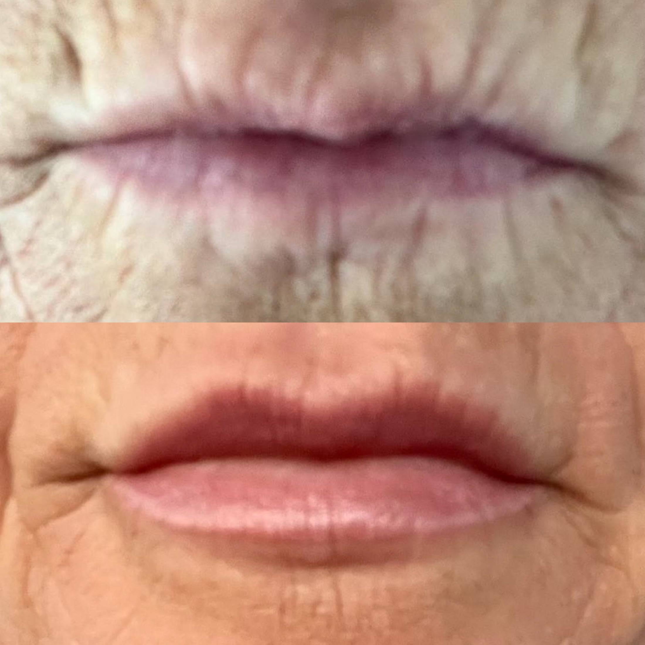 Rygerynker før og efter behandling hos Fyrsterling Clinic i Odense på Fyn