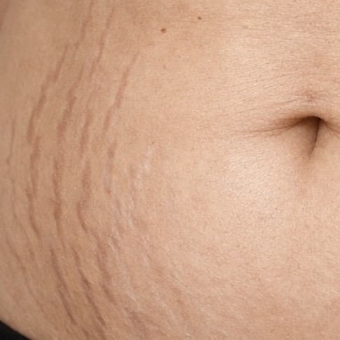 Strækmærker behandling hos Fyrsterling Clinic