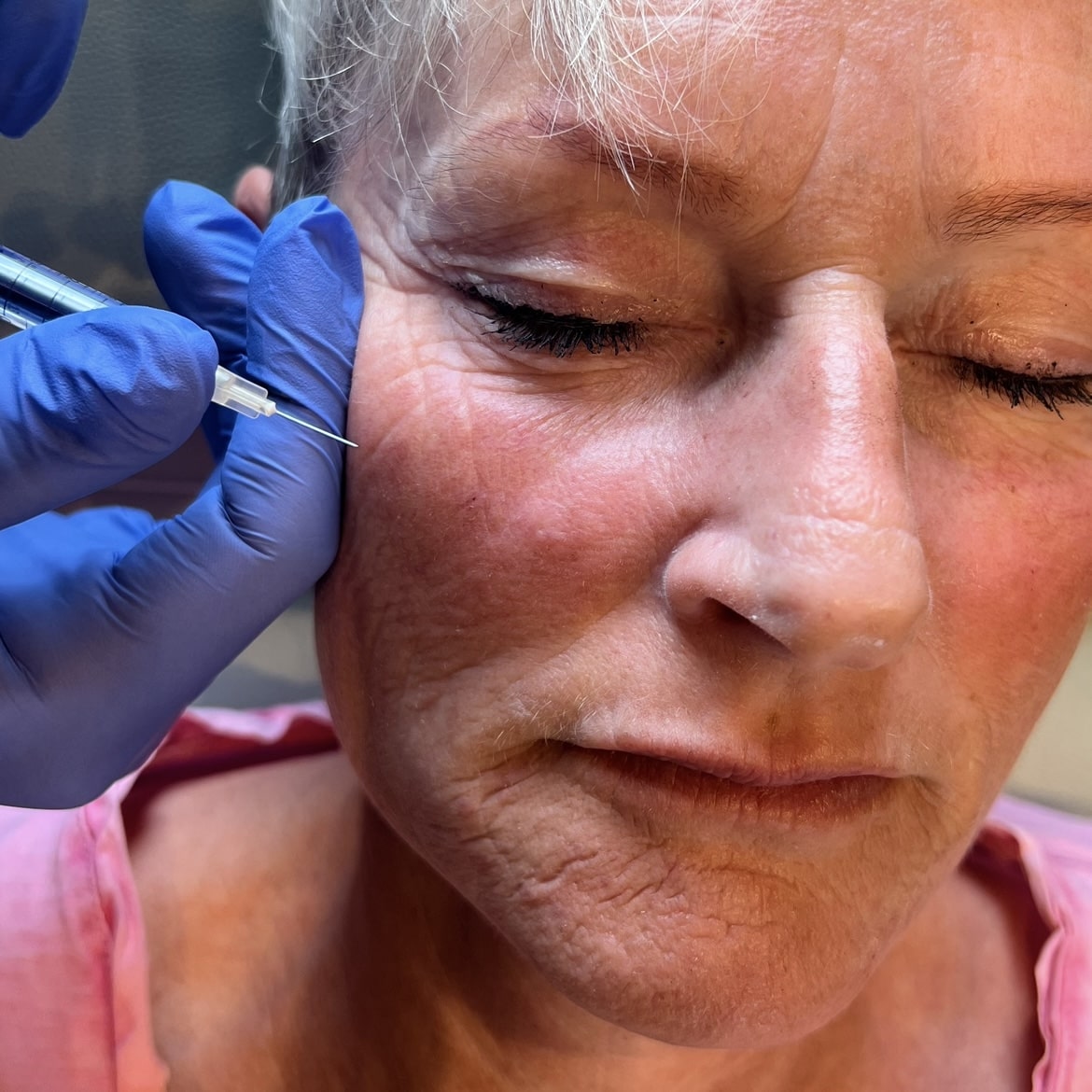 Kunde der får botox behandling hos skønhedssklinik Fyrsterling Clinic i Odense på Fyn