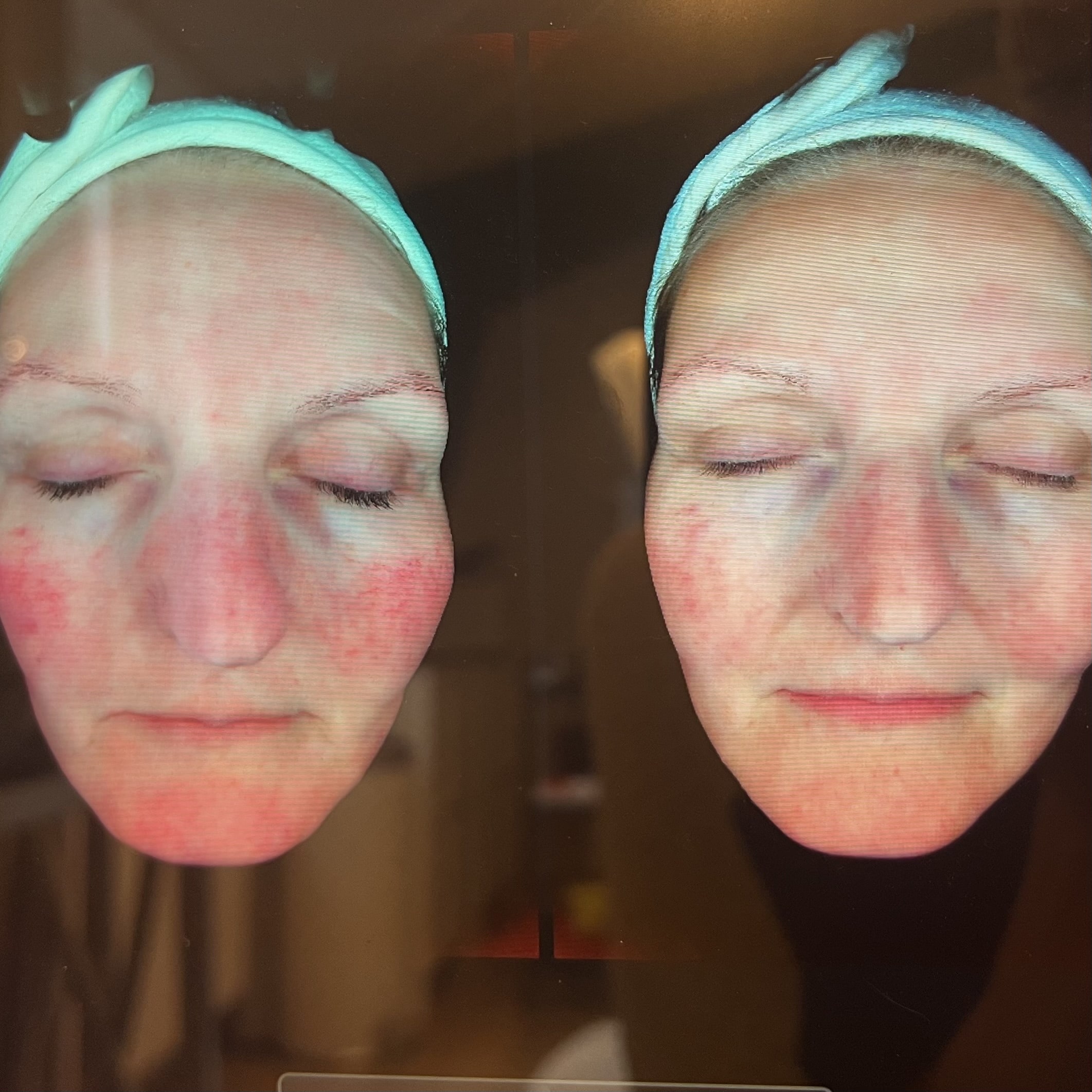 rosacea-hudanalyse-for-efter.jpg