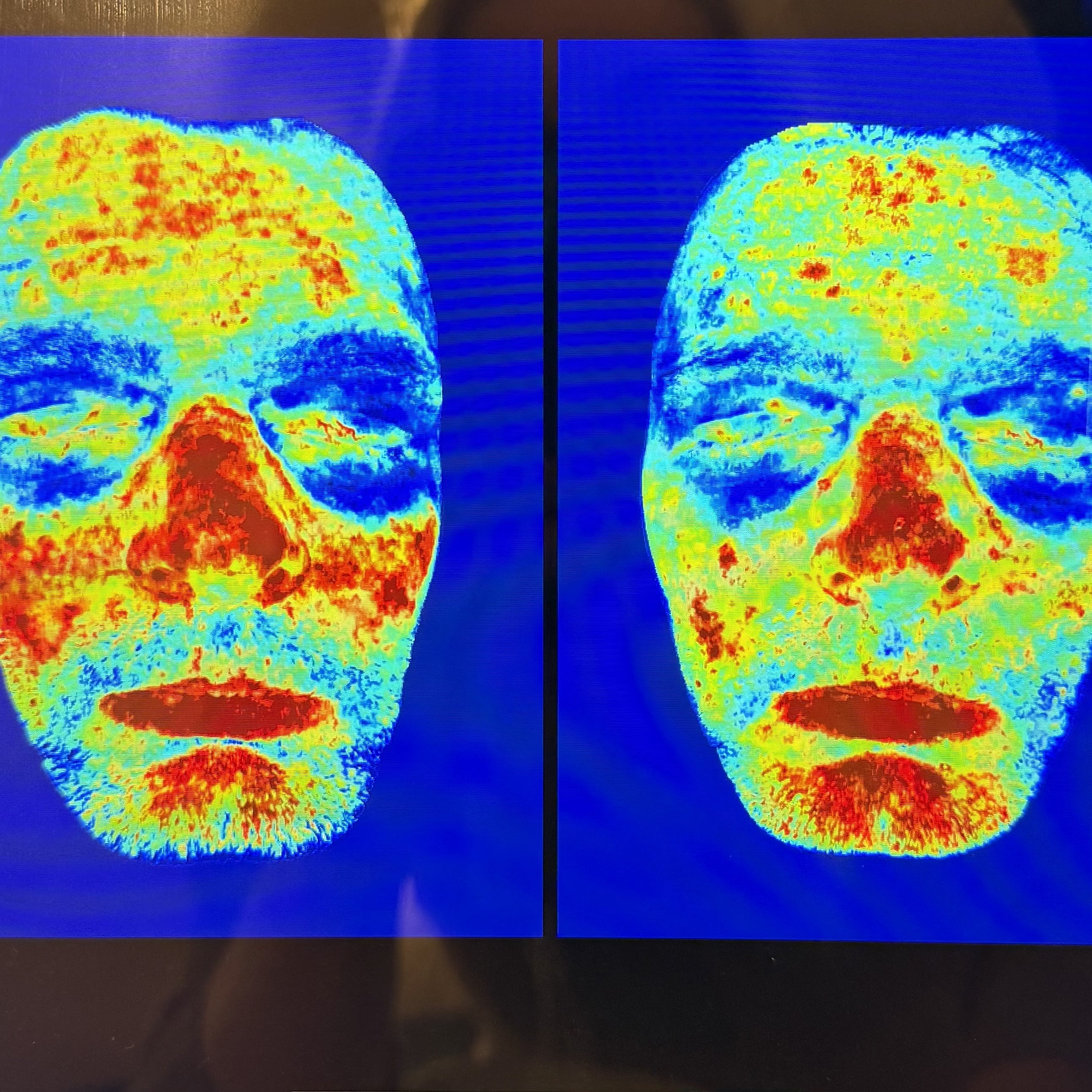 rosacea-kunde-for-efter.jpg