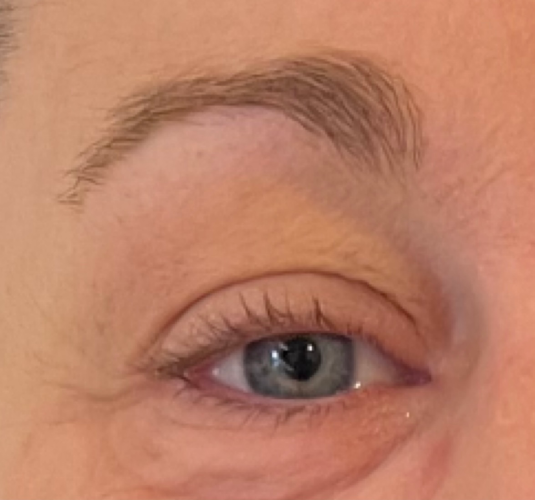 Efter brynløft med botox udført af Fyrsterling Clinic i Odense