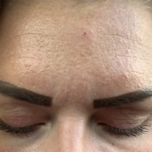 Før kunden har fået botox i panden, hvilket er udført i Odense