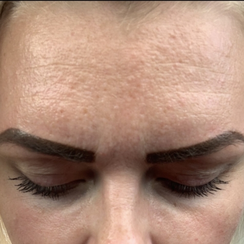 Før/efter billeder med ZO Skin Health hos Fyrsterling Clinic