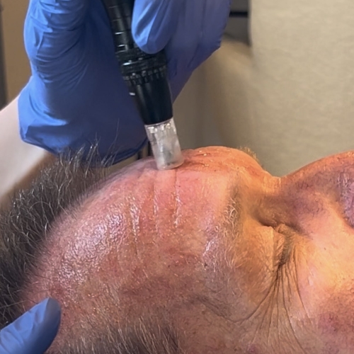 Kunde der får microneedling hos kosmetisk klinik i Odense på Fyn