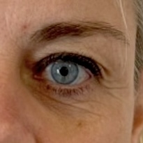 Før botox til brynløft udført af Fyrsterling Clinic i Odense
