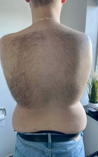 IPL permanent hårfjerning Fyrsterling Clinic før