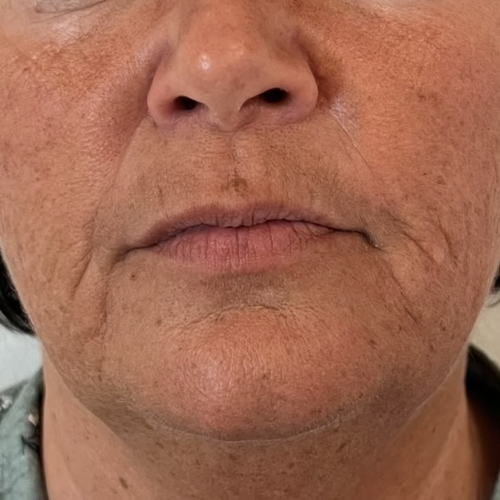 ZO Skin Health protokol lavet hos Fyrsterling Clinic på Fyn nær Svendborg