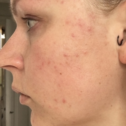 Kunde med akne hos kosmetisk klinik på Fyn