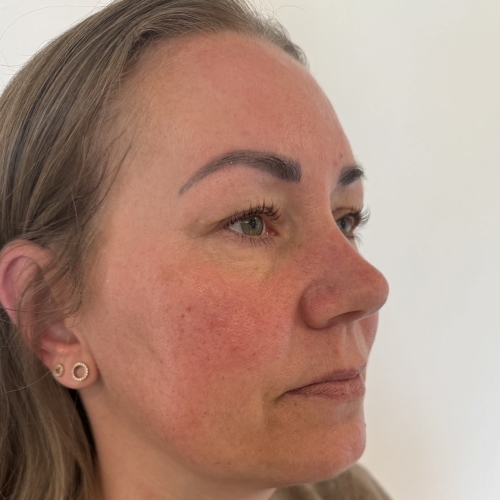 Kunde der har rosacea og er i behandling hos Fyrsterling Clinic i Odense