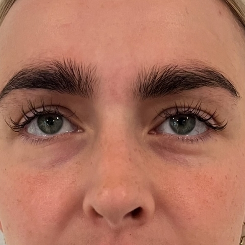 PRF skinbooster behandling hos Fyrsterling Clinic i Odense