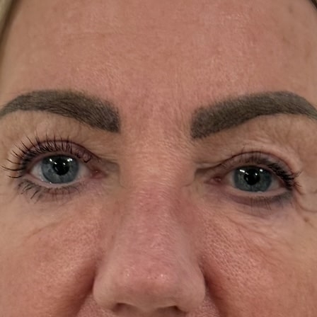 Kunde der skal have botox for et brynløft hos Fyrsterling Clinic i Odense