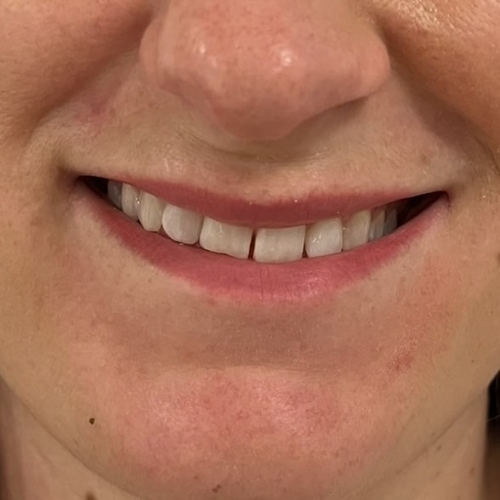 Botox behandling med lipflip til kunde hos skønhedsklinik i Odense
