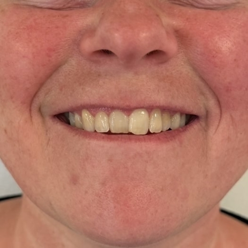 Kunder der har fået botox for lipflip hos kosmetisk klinik på Fyn
