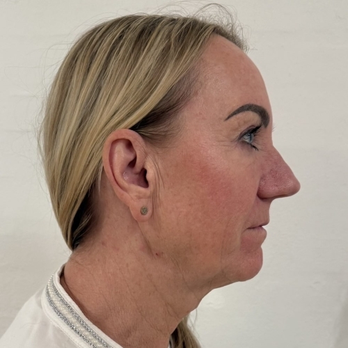 Kunde der skal have botox for nefertitisløft hos skønhedsklinik på Fyn