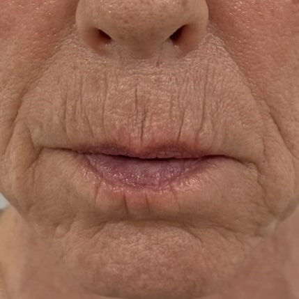 Kunde med rygerynker før behandling hos kosmetisk klinik i Odense på Fyn