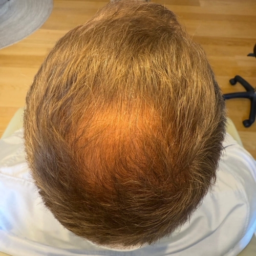 Behandling mod hårtab hos Fyrsterling Clinic i Odense