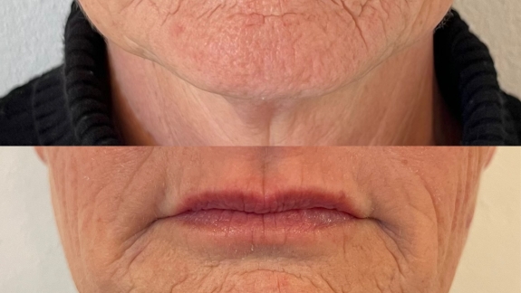 Før og efterbillede af ikke-permanent filler og skinbooster - Fyrsterling Clinic i Odense