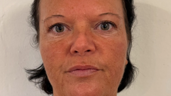 Før kunde har fået filler i kindben ved Fyrsterling Clinic i Odense