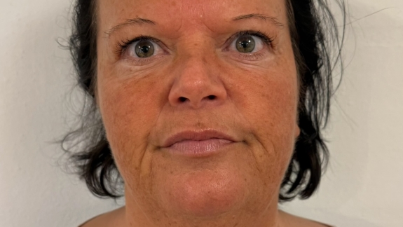 Før kunde har fået filler i kindben ved Fyrsterling Clinic i Odense