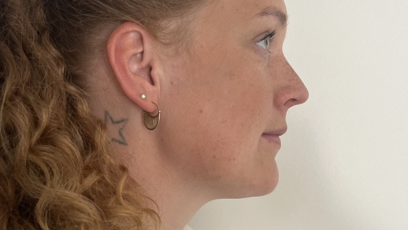 efter denne kunde har fået ikke-permanent filler i hage, kæbevinkel og kæbelinje. 