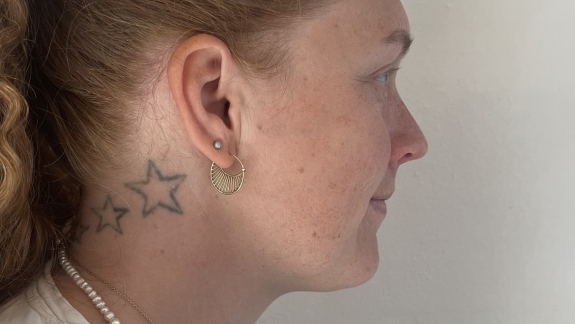 før denne kunde har fået ikke-permanent filler i hage, kæbevinkel og kæbelinje. 