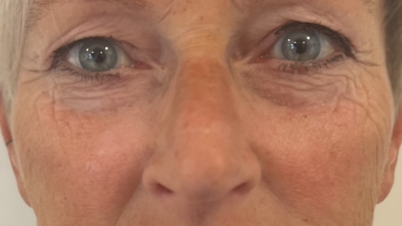 efter denne kunde har fået ikke-permanent filler i kinderne