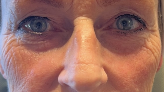før denne kunde har fået ikke-permanent filler i kinderne