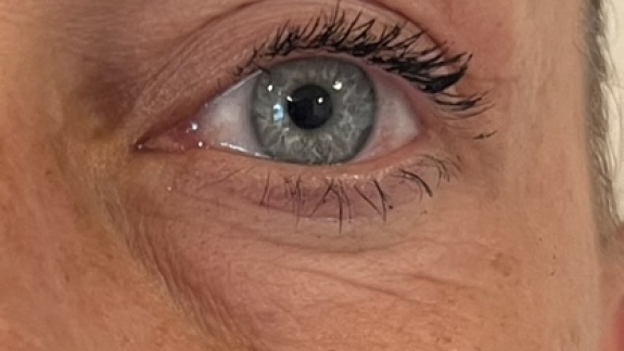 Før ikke-permanent filler under øjnene hos Fyrsterling Clinic i Odense
