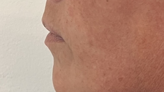 Før ikke-permanent filler i hagen hos Fyrsterling Clinic på Fyn