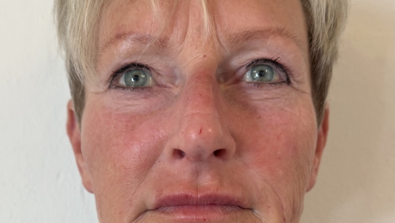 Kunde der har fået filler for forfinelse i ansigtet hos kosmetisk klinik i Odense