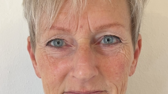 Kunde der har fået filler for forfinelse i ansigtet hos kosmetisk klinik i Odense