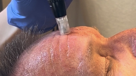 Kunde der får microneedling hos kosmetisk klinik i Odense på Fyn