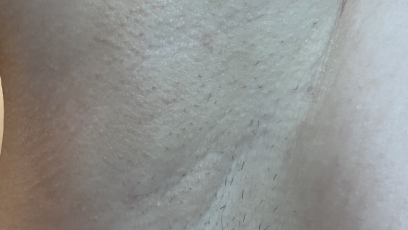 IPL permanent hårfjerning i kosmetisk klinik i Odense på Fyn