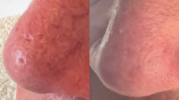 Kunde der får microneedling hos kosmetisk klinik i Odense på Fyn