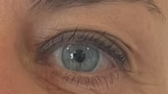 Efter behandling med botox til brynløft udført af Fyrsterling Clinic