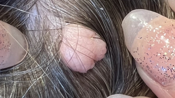 Fjernelse af gevækst hos Fyrsterling Clinic