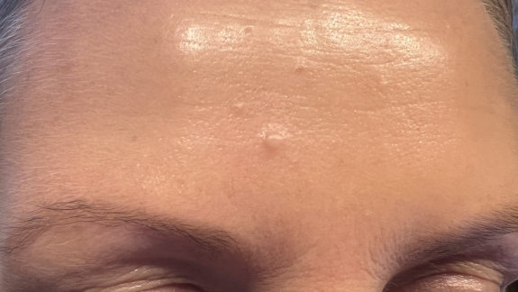 Fjernelse af gevækst på hud hos Fyrsterling Clinic