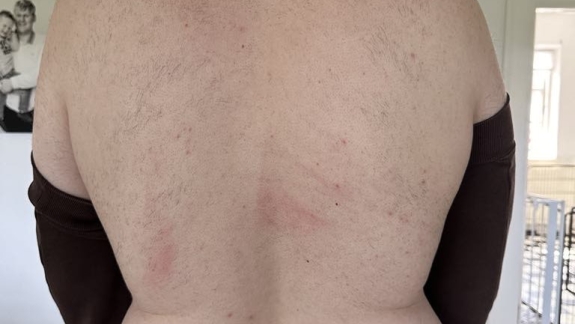 IPL permanent hårfjerning Fyrsterling Clinic efter