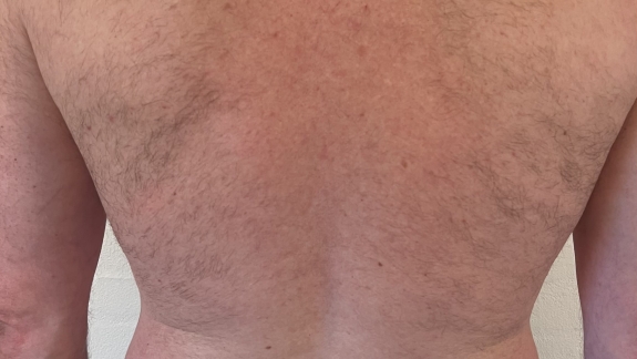 IPL permanent hårfjerning ryg efter