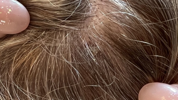 Fjernelse af gevækst hos Fyrsterling Clinic