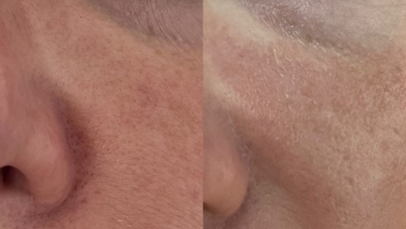 Kunde der får microneedling hos kosmetisk klinik i Odense på Fyn